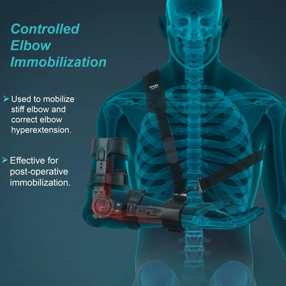 Tynor ROM Elbow Brace – Adjustable Range of Motion Support (Ref: E-46)